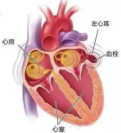 人到中年，如何避免腦梗死，做到三個(gè)堅(jiān)決，讓你生活更健康