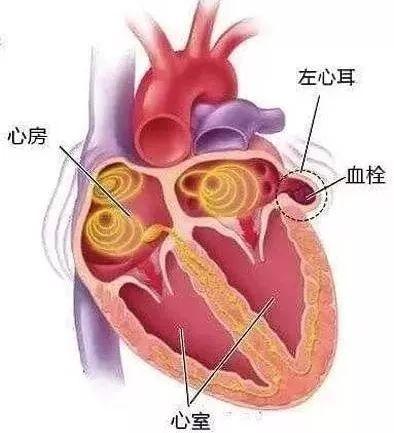 人到中年，如何避免腦梗死，做到三個(gè)堅(jiān)決，讓你生活更健康