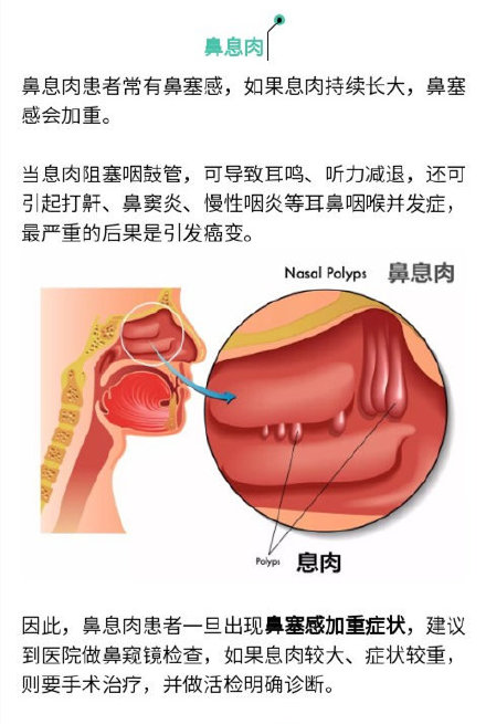 “息肉”離癌癥有多遠(yuǎn)？腫瘤專家：這樣的最危險(xiǎn)