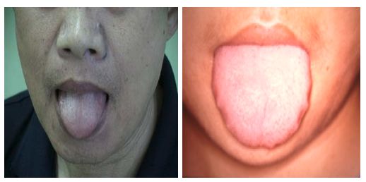 最容易被忽視的腫瘤征兆！如何提早發(fā)現(xiàn)？內(nèi)附權(quán)威自測表