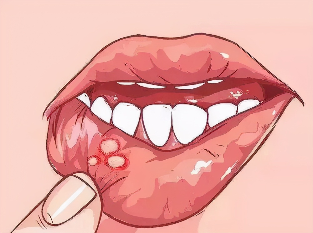 有一種痛，叫口腔潰瘍，補(bǔ)充維C不頂用，這些辦法才靠譜