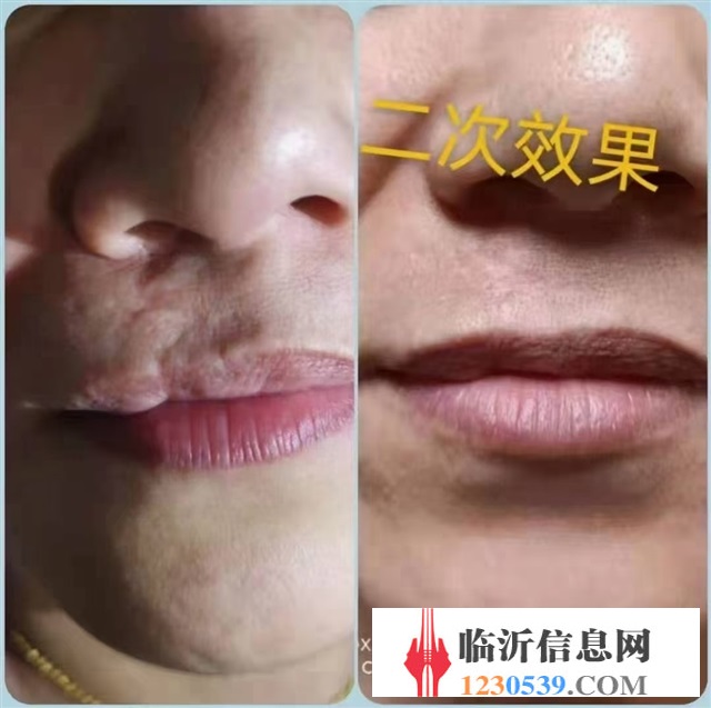 修復(fù)斑疤痘敏，各種問題性皮膚