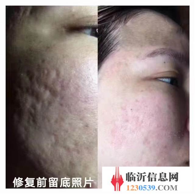 修復(fù)斑疤痘敏，各種問題性皮膚