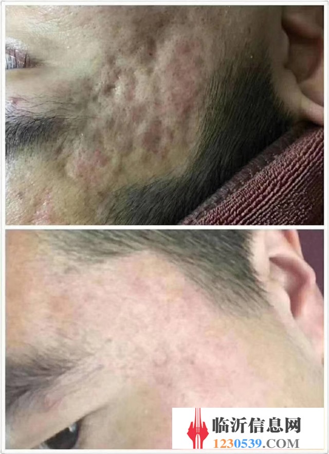 修復(fù)斑疤痘敏，各種問題性皮膚