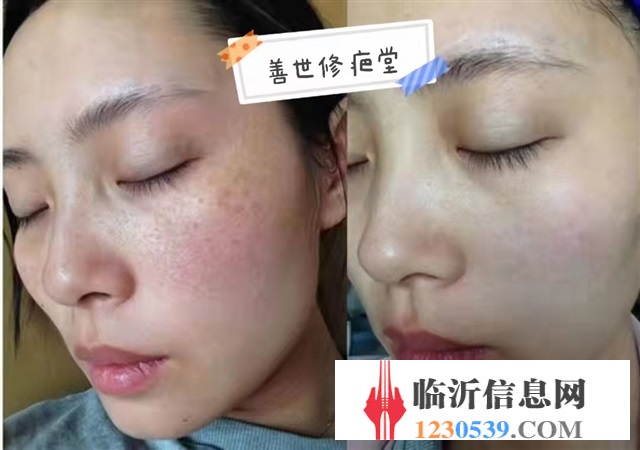 修復(fù)斑疤痘敏，各種問題性皮膚